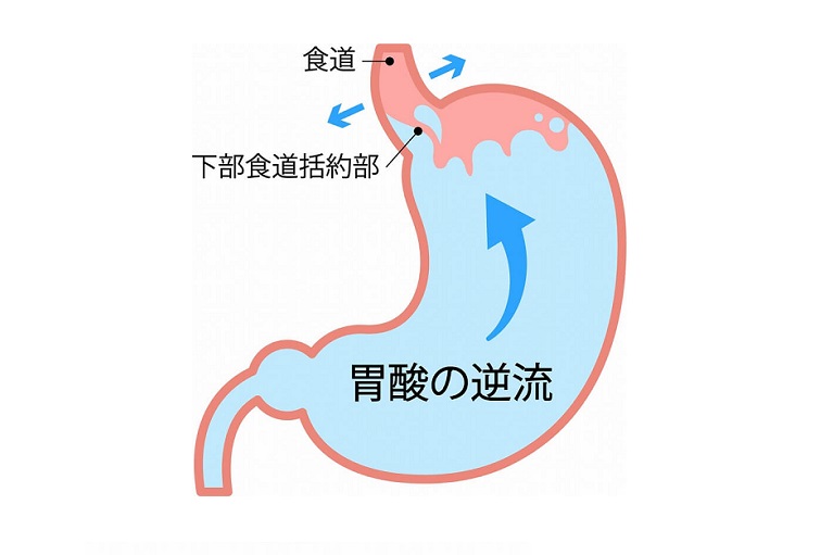 胃炎 胃がん 逆流性食道炎 胃の痛み 吐き気 嘔吐 背中の痛みなど 大阪市東淀川区のあけぼのgmクリニック